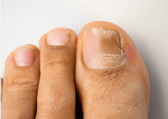 fungal-nail-infection