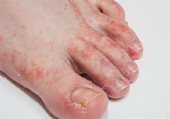 Athlete’s Foot Condition-1