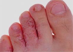 Athlete’s Foot Condition-3